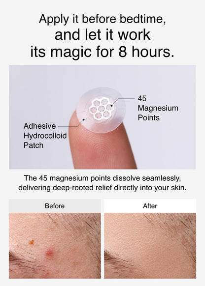 MOONBIFFY Quick Calming Magnesium Pimple Patches – Acne Spot Treatment with Tweezers & Ampoule