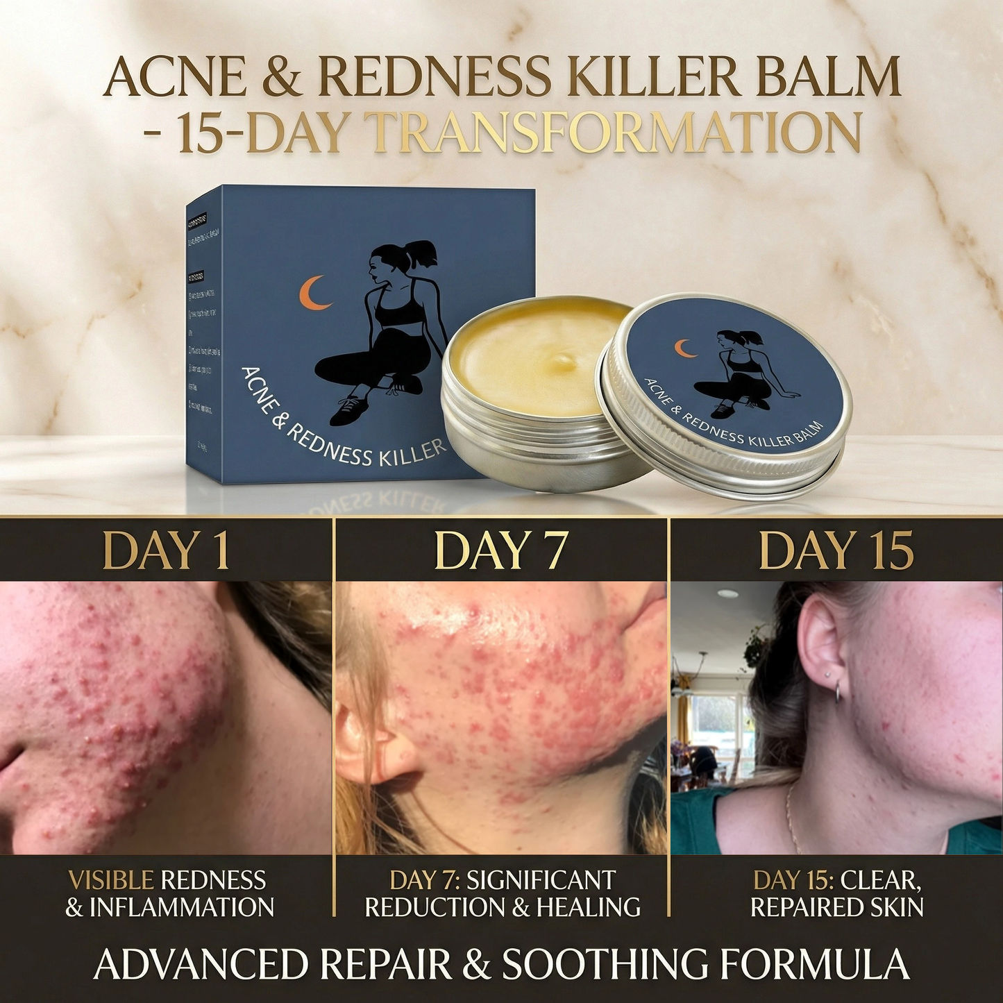 New-Gen Acne & Redness Killer Balm: Clearer Skin, Less Redness, Faster Recovery