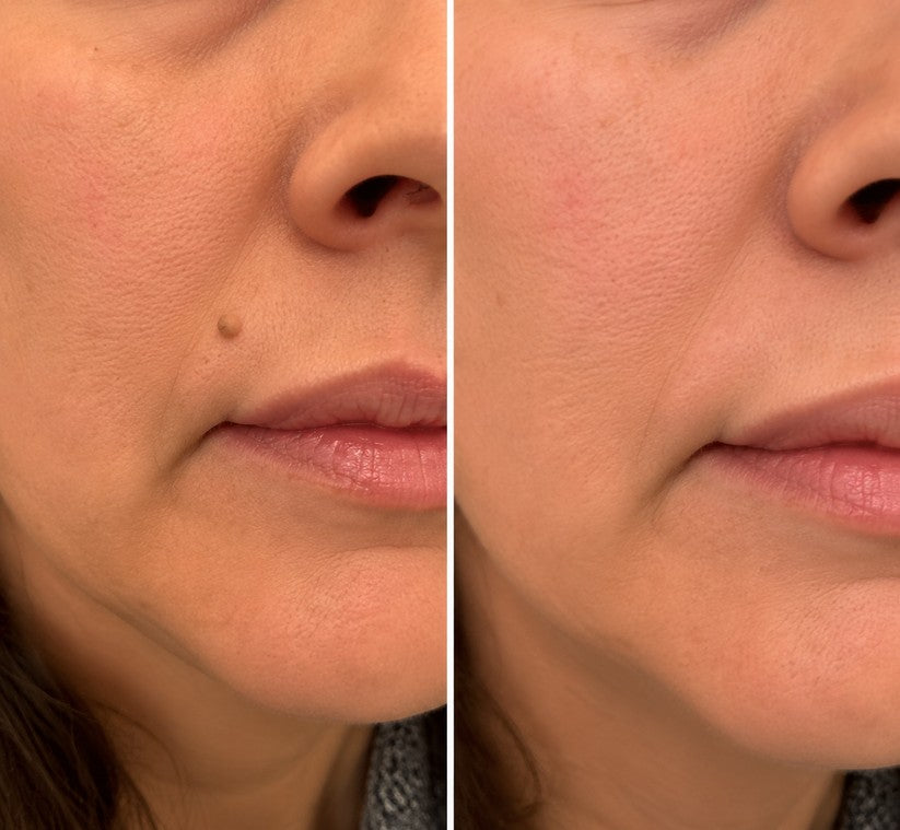 🌟 Cheemex® 2-in-1 Microneedle & Hydrocolloid Patch 🌿 Invisible Face & Body Patches for Raised Moles, Acne, Flat Warts & Skin Tags - Helps Improve the Appearance of Wrinkles, Scars & Blemishes