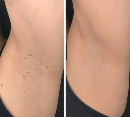 🌟 Cheemex® 2-in-1 Microneedle & Hydrocolloid Patch 🌿 Invisible Face & Body Patches for Raised Moles, Acne, Flat Warts & Skin Tags - Helps Improve the Appearance of Wrinkles, Scars & Blemishes